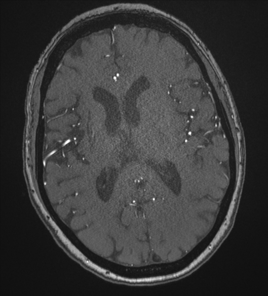 File:Bilateral fetal posterior communicating arteries (Radiopaedia 41286-44102 Axial MRA 125).png