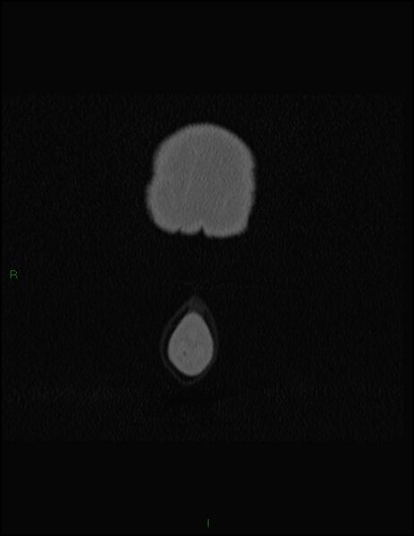 File:Bilateral frontal mucoceles (Radiopaedia 82352-96454 Coronal 10).jpg