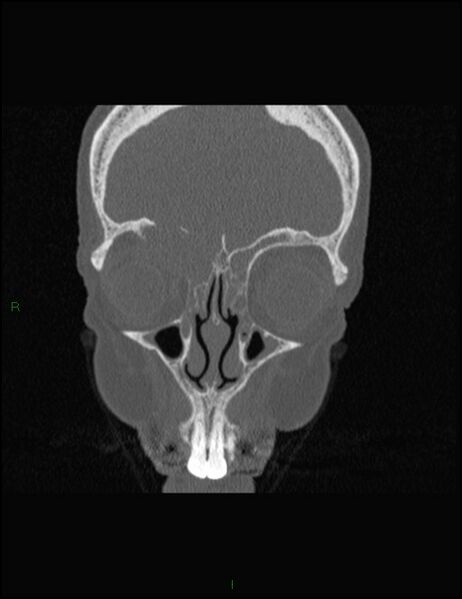 File:Bilateral frontal mucoceles (Radiopaedia 82352-96454 Coronal 100).jpg