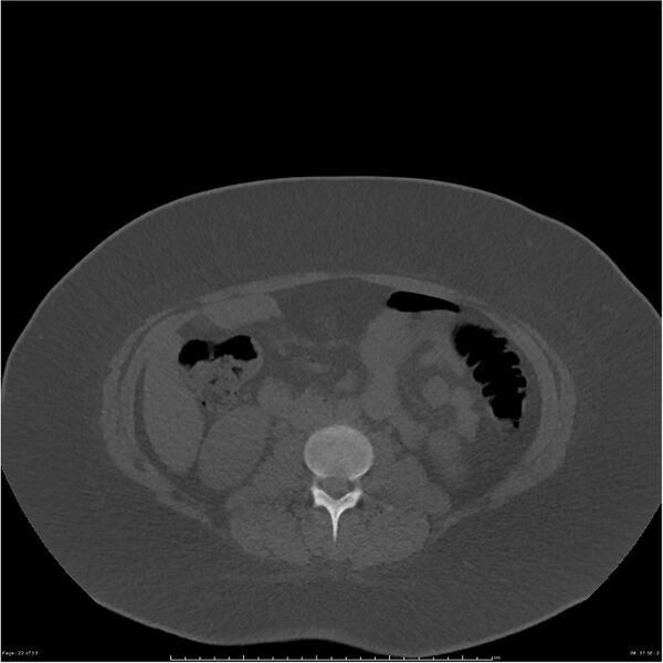 File:Bilateral lumbar ribs (Radiopaedia 25862-26010 bone window 22).jpg