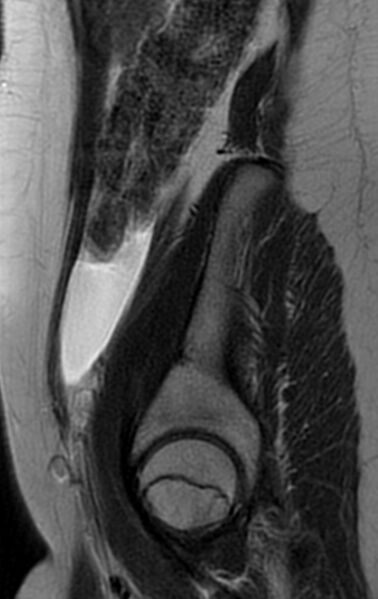 File:Bilateral ovarian fibrothecomas - adolescent (Radiopaedia 86604-102707 Sagittal T2 4).jpg