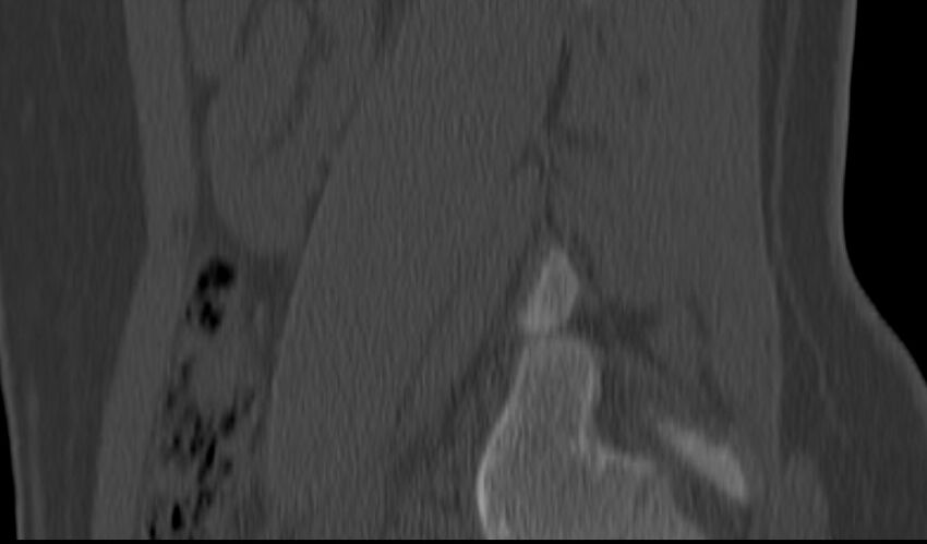 Bilateral pars defect (Radiopaedia 26691-26846 Sagittal bone window 12).jpg
