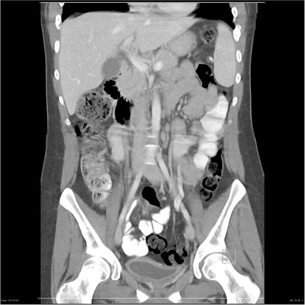 File:Bilateral ureteritis and cystitis (Radiopaedia 25340-25594 B 18).jpg