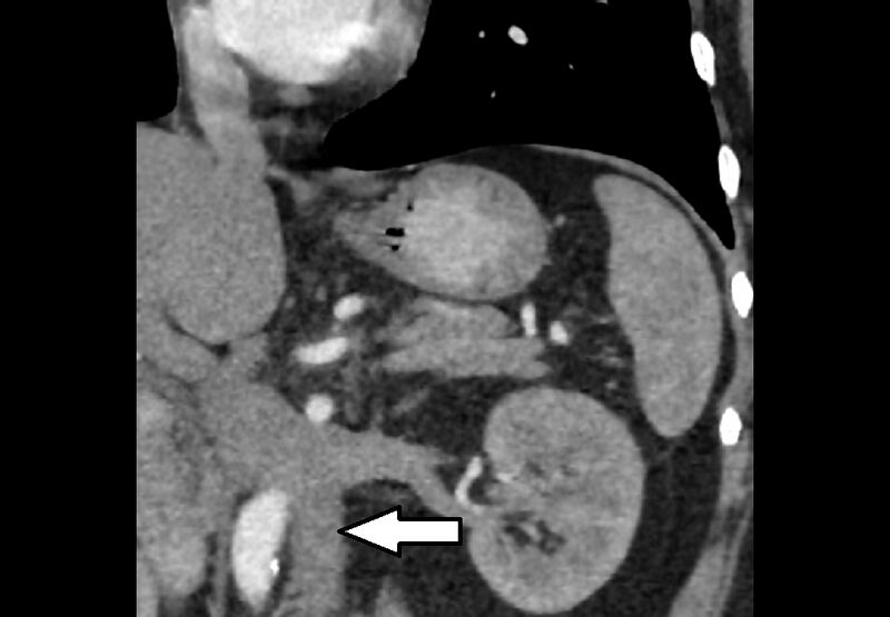 File:Bilateral urolithiasis with incidentally detected splenic artery aneurysm and left inferior vena cava (Radiopaedia 44467-48130 Mutiple 4).jpg