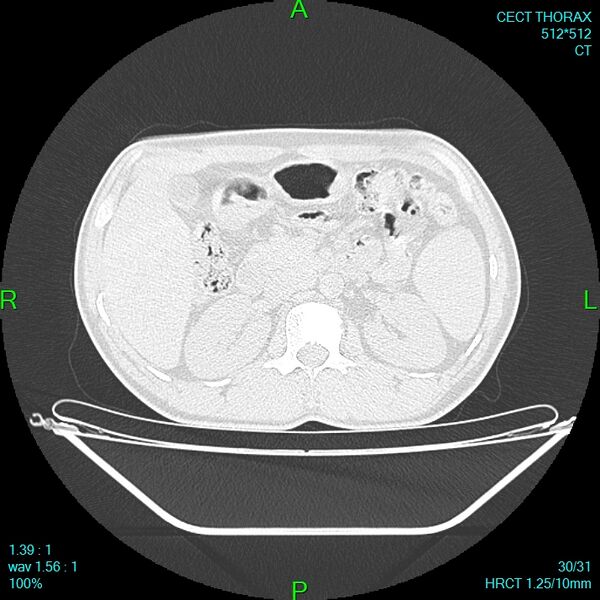 File:Bone metastases from lung carcinoma (Radiopaedia 54703-60937 Axial lung window 30).jpg