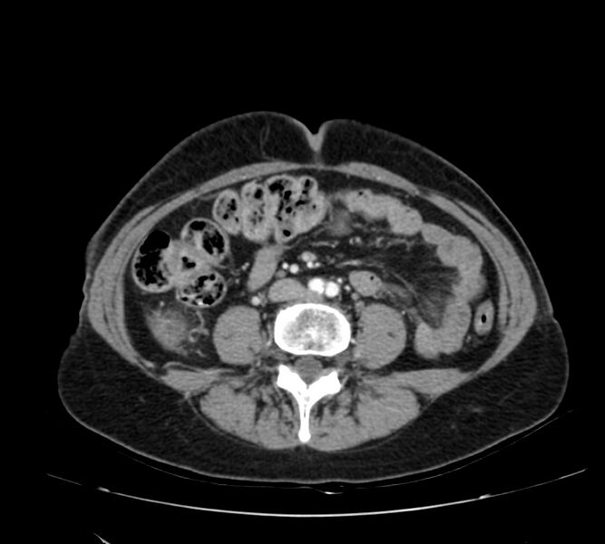 File:Bosniak renal cyst - type IV (Radiopaedia 22929-22953 B 67).jpg