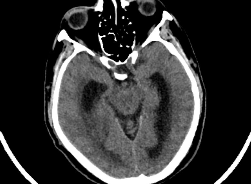 File:Brain abscess complicated by intraventricular rupture and ventriculitis (Radiopaedia 82434-96575 Axial non-contrast 17).jpg