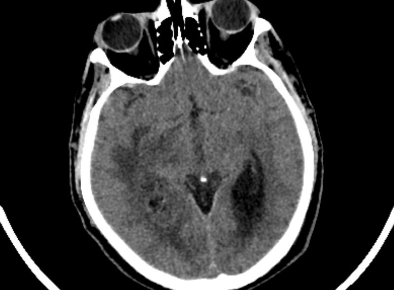 File:Brain abscess complicated by intraventricular rupture and ventriculitis (Radiopaedia 82434-96575 Axial non-contrast 28).jpg