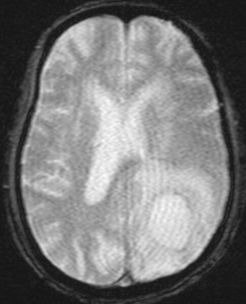File:Brain abscess with dual rim sign (Radiopaedia 87566-103938 Axial SWI 14).jpg