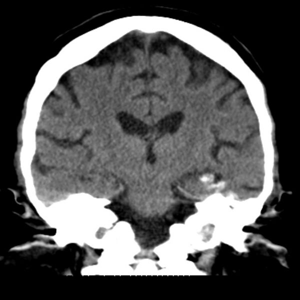 File:Brain cortical laminar necrosis (Radiopaedia 25822-25971 C 31).jpg