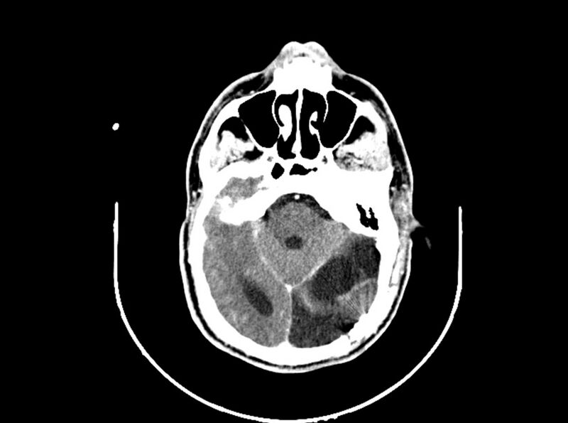 File:Brain injury by firearm projectile (Radiopaedia 82068-96088 B 96).jpg