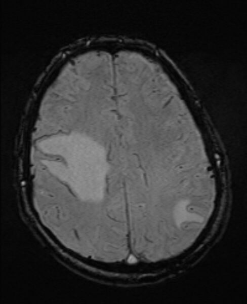 File:Brain metastases - lung cancer primary (Radiopaedia 75060-86115 Axial SWI 43).jpg