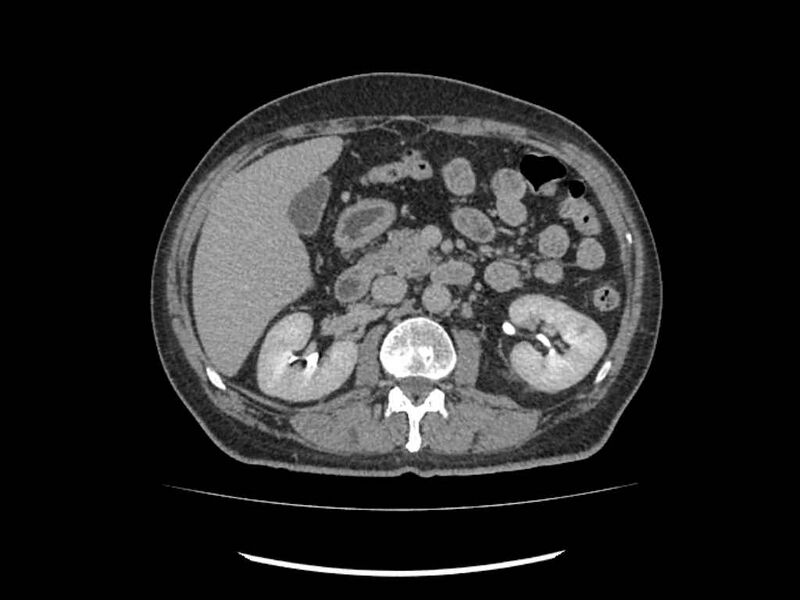 File:Brain metastases from renal cell carcinoma (Radiopaedia 42222-45328 Axial C+ delayed 88).jpg