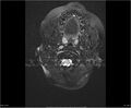 Brainstem glioma (Radiopaedia 21819-21775 Axial FLAIR 2).jpg