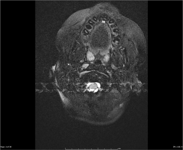 File:Brainstem glioma (Radiopaedia 21819-21775 Axial FLAIR 2).jpg