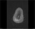Brainstem glioma (Radiopaedia 21819-21775 Axial FLAIR 38).jpg