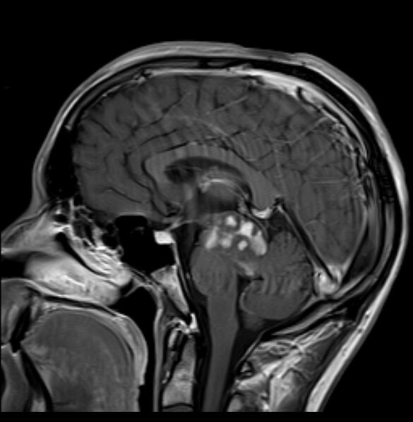 File:Brainstem glioma - focal midbrain (Radiopaedia 6525-67551 Sagittal T1 C+ 1).jpg