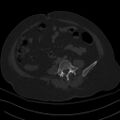 Breast carcinoma with pathological hip fracture (Radiopaedia 60314-67993 Axial bone window 7).jpg