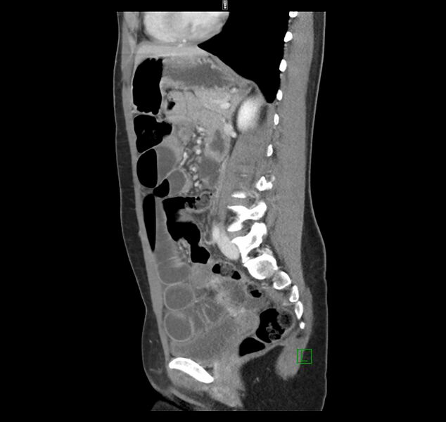 File:Broad ligament hernia (Radiopaedia 63260-71832 C 32).jpg