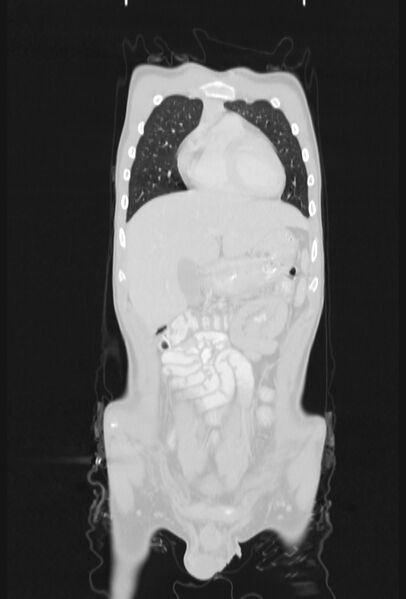 File:Bronchial carcinoid tumor (Radiopaedia 57187-64090 Coronal lung window 18).jpg