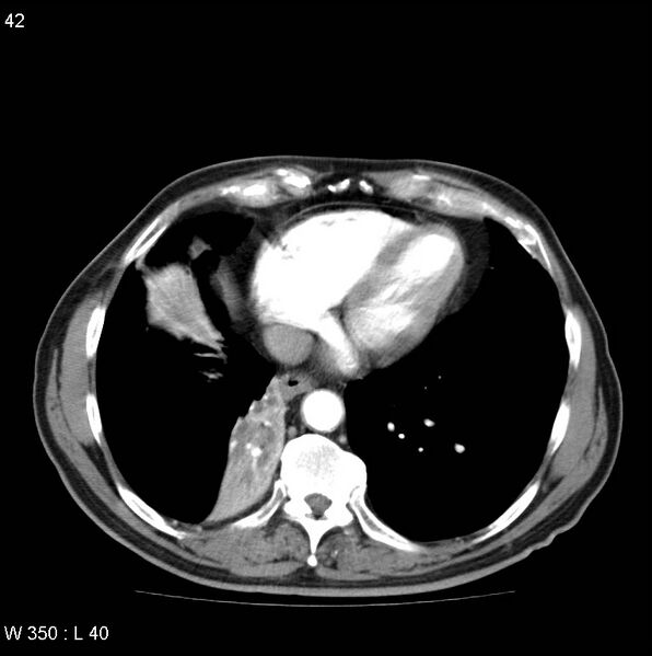File:Bronchial carcinoid tumor with right lower lobe collapse (Radiopaedia 29060-29422 A 41).jpg