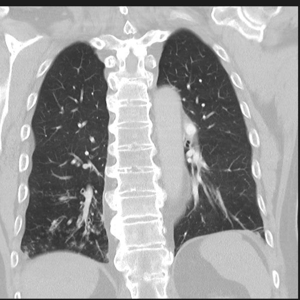 File:Bronchiectasis (Radiopaedia 39385-41666 Coronal lung window 24).png