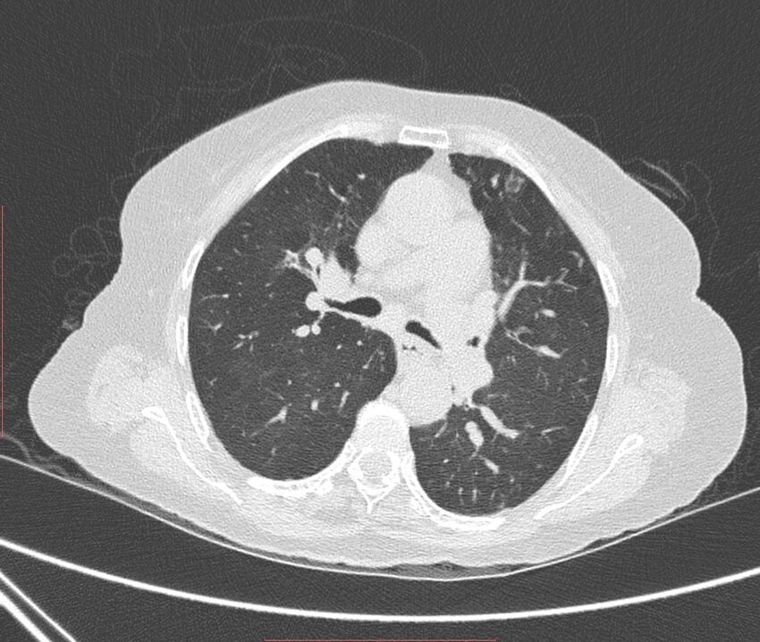 Bronchiectasis (Radiopaedia 72693-83293 Axial lung window 55).jpg