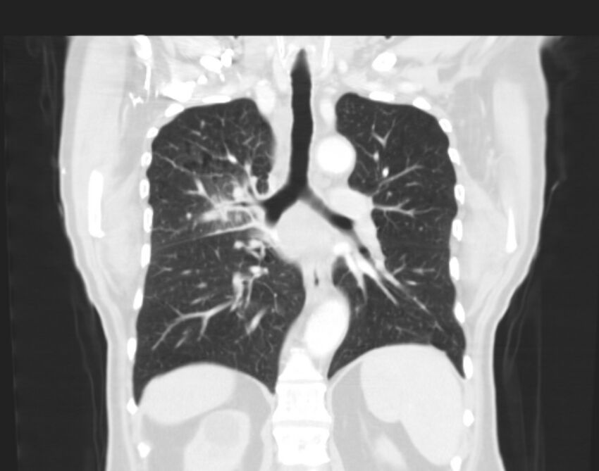 Bronchogenic carcinoma with lymphangitic spread (Radiopaedia 29002-29357 Coronal lung window 43).jpg