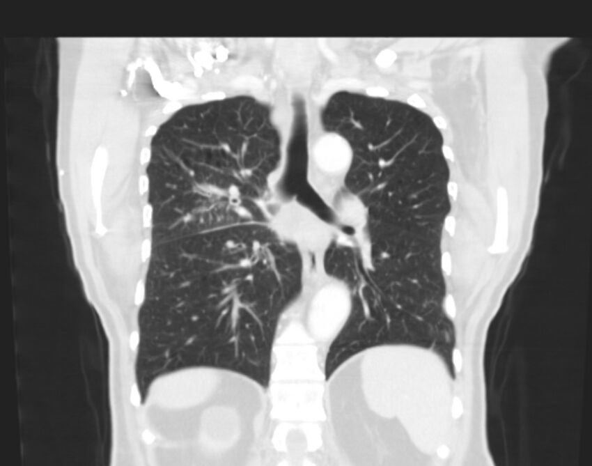 Bronchogenic carcinoma with lymphangitic spread (Radiopaedia 29002-29357 Coronal lung window 46).jpg