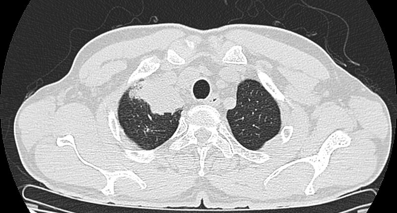 File:Bronchogenic carcinoma with superior vena cava syndrome (Radiopaedia 36497-38054 Axial lung window 13).jpg