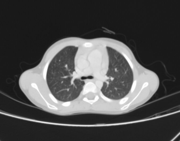 File:Bronchus suis (Radiopaedia 68131-77620 Axial lung window 27).jpg