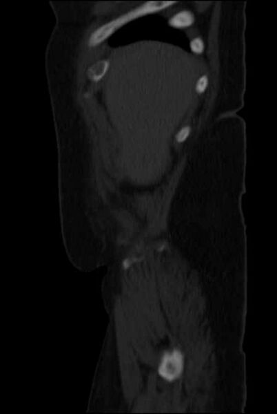 File:Brown tumors compressing the spinal cord (Radiopaedia 68442-77988 H 7).jpg
