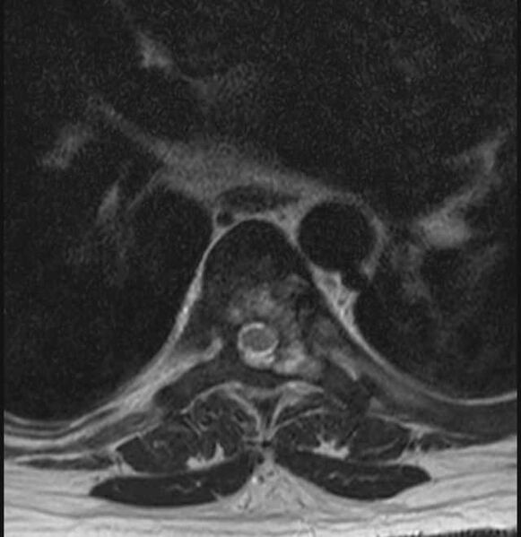 File:Brown tumors compressing the spinal cord (Radiopaedia 68442-78030 A 32).jpg