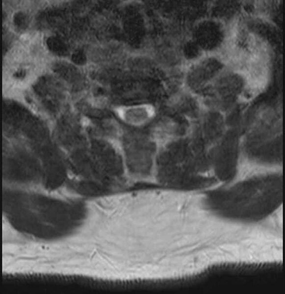 File:Brown tumors compressing the spinal cord (Radiopaedia 68442-78030 A 57).jpg