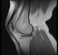 Bucket handle tear - medial meniscus (Radiopaedia 24900-25163 Sagittal T2 11).png