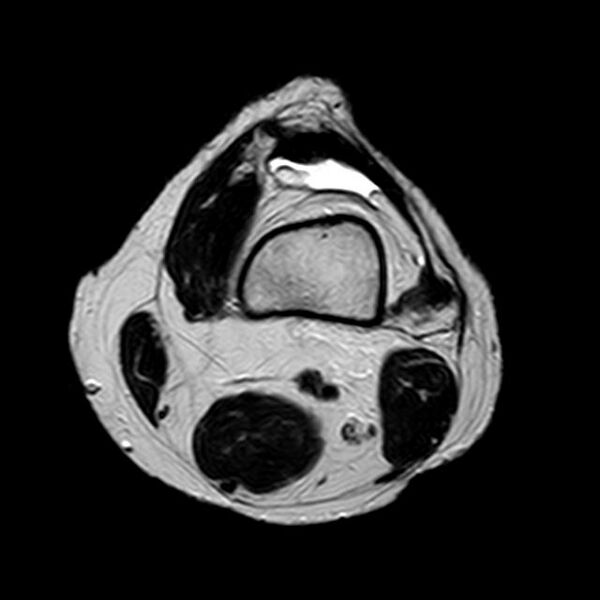 File:Bucket handle tear - medial meniscus (Radiopaedia 29250-29664 Axial T2 18).jpg