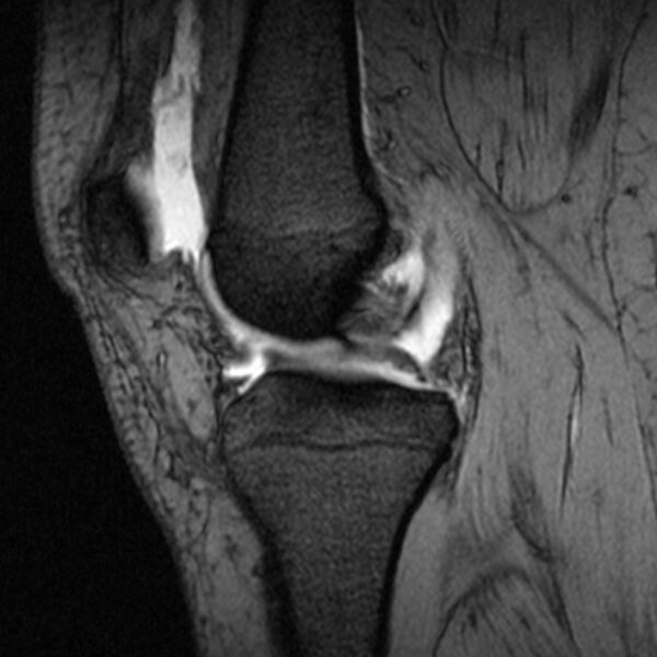 File:Bucket handle tear - medial meniscus (Radiopaedia 79028-91942 D 15).jpg