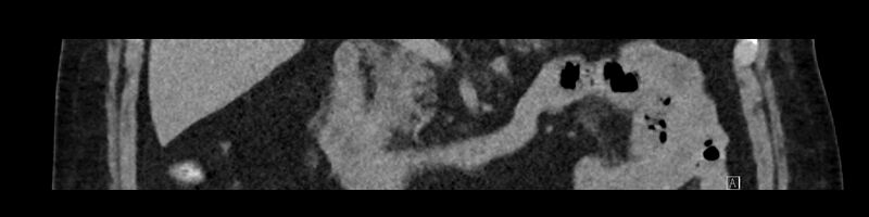 File:Buried bumper syndrome - gastrostomy tube (Radiopaedia 63843-72575 Coronal Inject 45).jpg