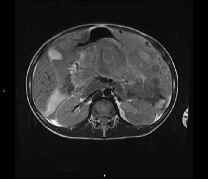 File:Burkitt lymphoma (bowel) (Radiopaedia 68839-78557 Axial T2 23).jpg