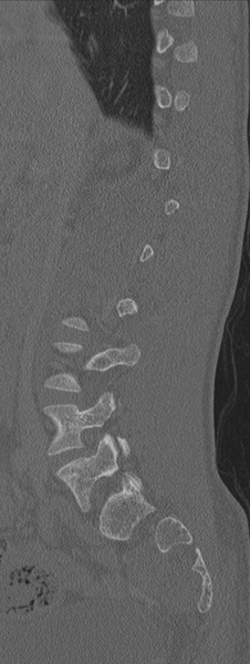 File:Burst fracture - T12 with conus compression (Radiopaedia 56825-63647 Sagittal bone window 58).png