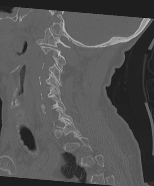 File:C2 fracture with vertebral artery dissection (Radiopaedia 37378-39199 Sagittal bone window 28).png