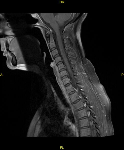File:C5 nerve sheath tumor (Radiopaedia 85777-101596 F 11).jpg