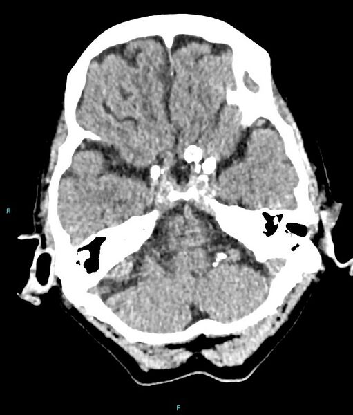 File:Calcified cerebral emboli from left ventricular thrombus (Radiopaedia 84420-99758 Axial non-contrast 71).jpg