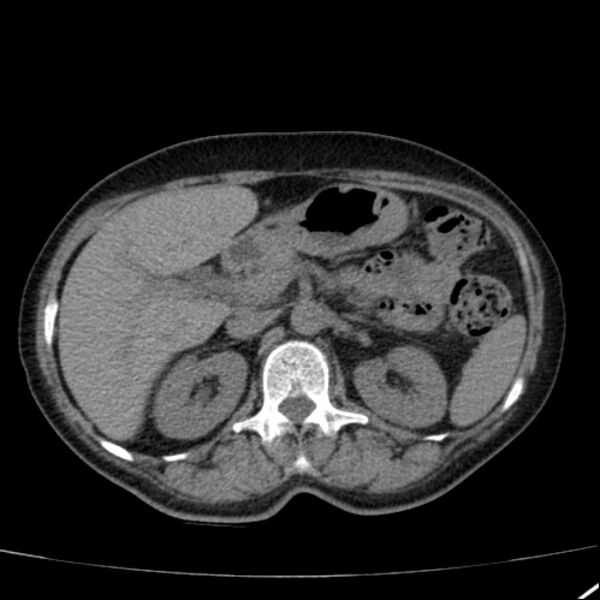 File:Calcified hepatic hydatid cyst (Radiopaedia 26872-27046 Axial non-contrast 30).jpg