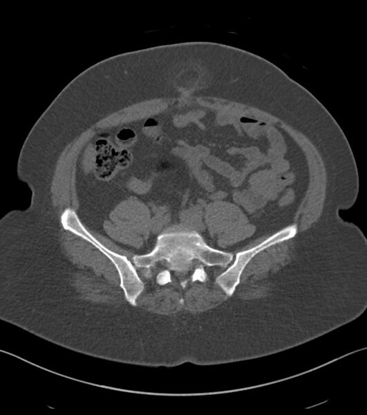 File:Calcified hepatic hydatid cyst (Radiopaedia 81127-94738 Axial non-contrast 71).jpg