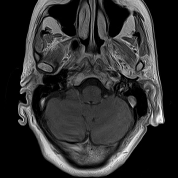 File:Calcified meningioma - cervical canal (Radiopaedia 70136-82468 Axial T1 C+ 2).jpg