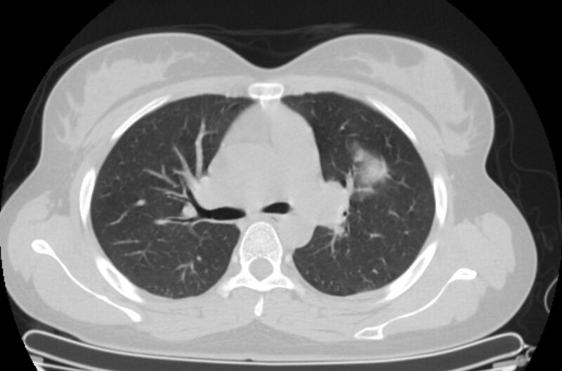 File:Cannonball metastases - uterine choriocarcinoma (Radiopaedia 70137-80173 Axial lung window 32).jpg
