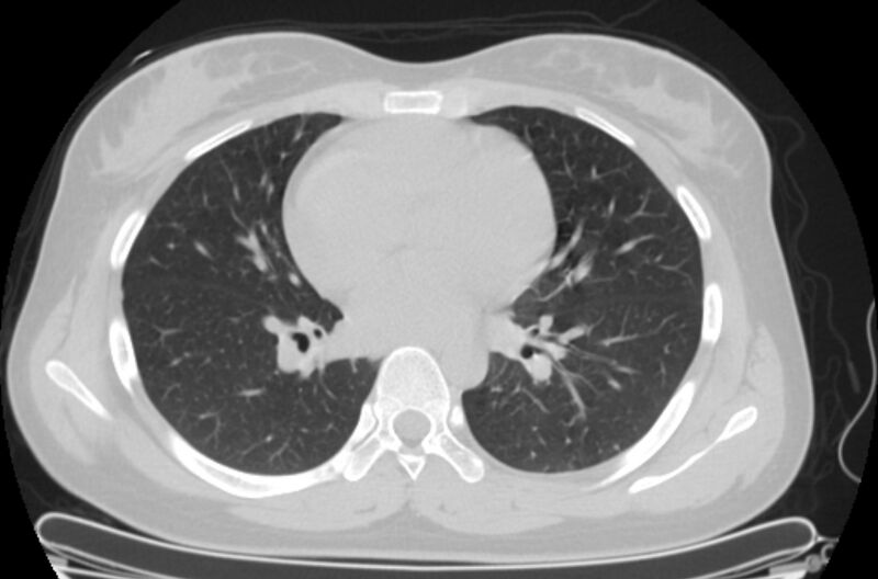 File:Cannonball metastases - uterine choriocarcinoma (Radiopaedia 70137-80173 Axial lung window 56).jpg