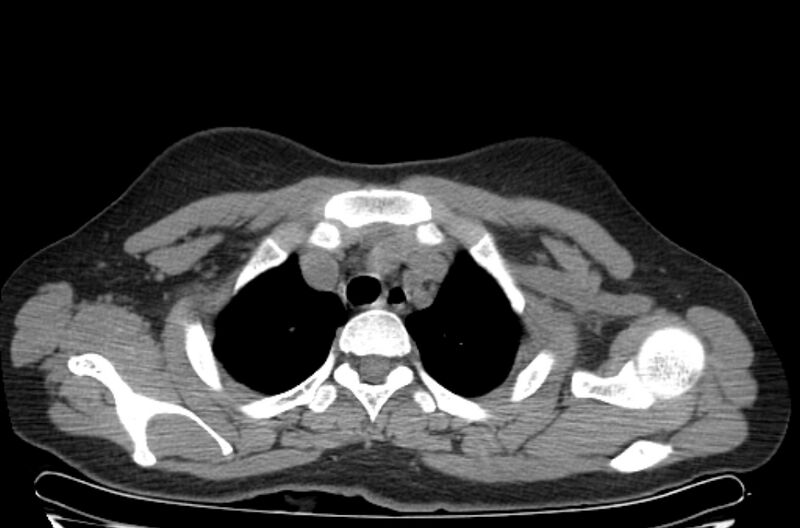 File:Cannonball metastases - uterine choriocarcinoma (Radiopaedia 70137-80173 Axial non-contrast 10).jpg