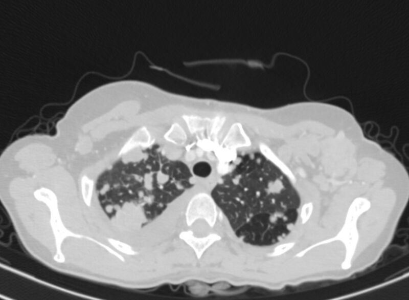 File:Cannonball metastases from breast cancer (Radiopaedia 91024-108569 Axial lung window 13).jpg